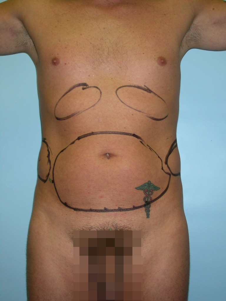 Male Liposuction Before and After Pictures Miami, FL