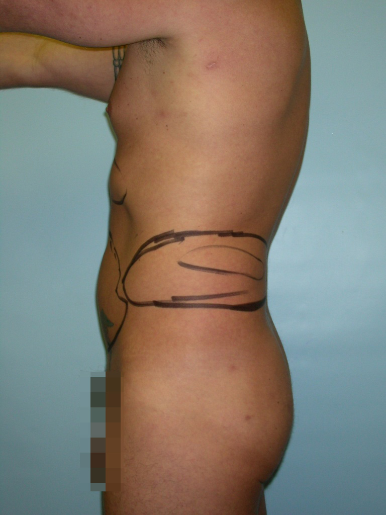 Male Liposuction Before and After Pictures Miami, FL