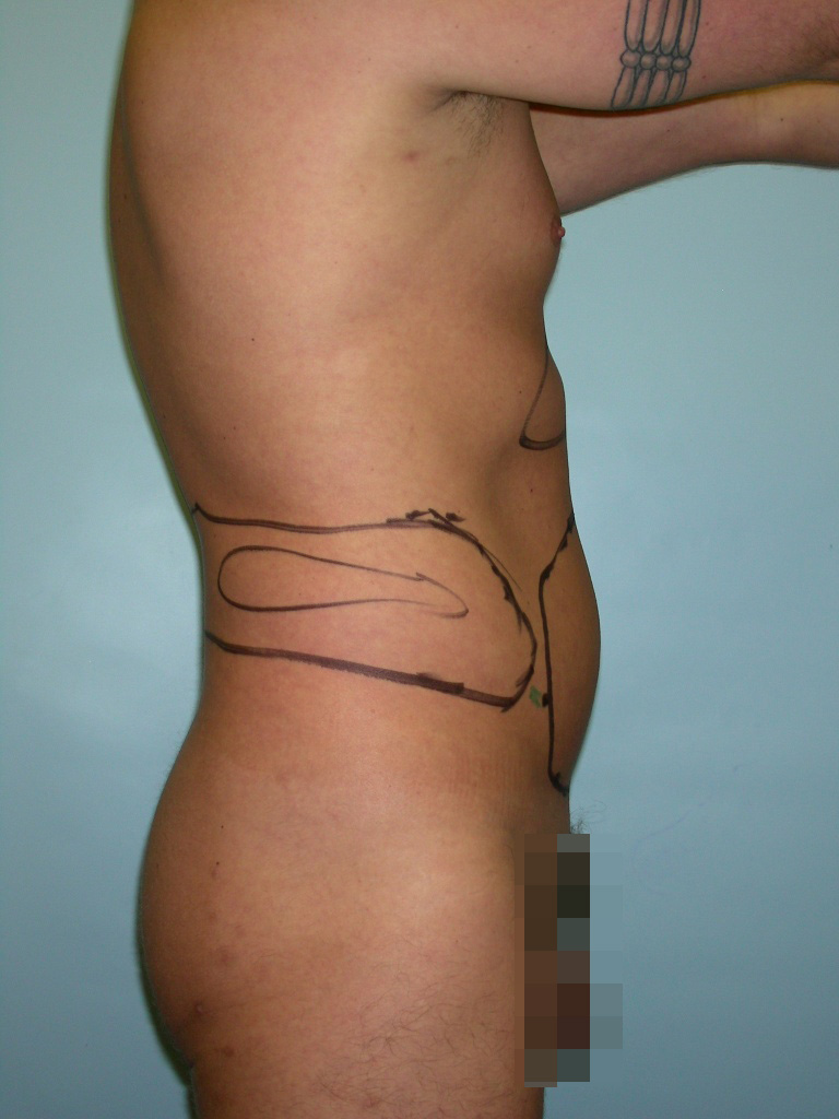 Male Liposuction Before and After Pictures Miami, FL