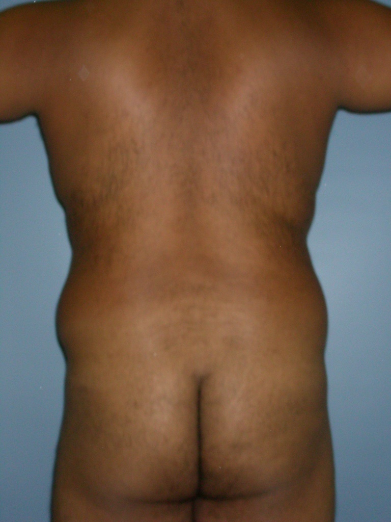 Male Liposuction Before and After Pictures Miami, FL