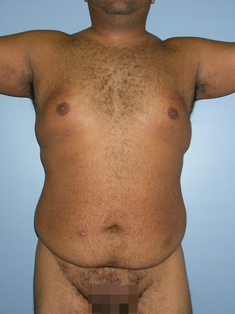 Male Liposuction Before and After Pictures Miami, FL