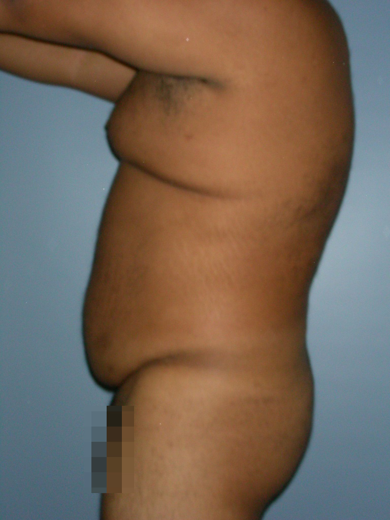 Male Liposuction Before and After Pictures Miami, FL