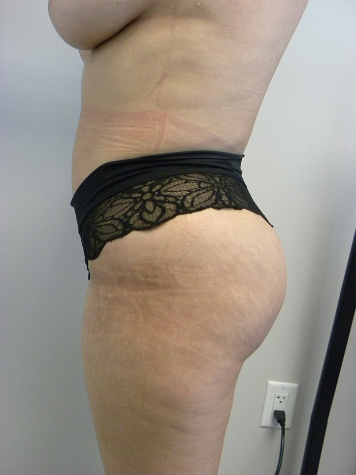 Liposuction Before and After Pictures Miami, FL