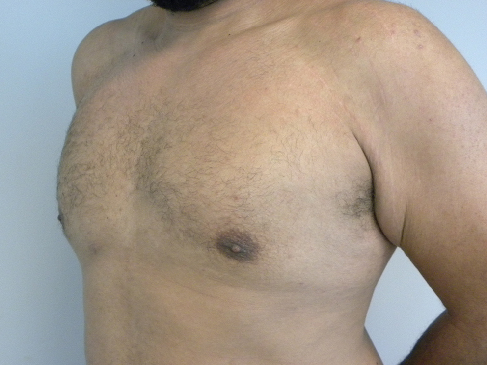 Liposuction and Gynecomastia Before and After Pictures Miami, FL