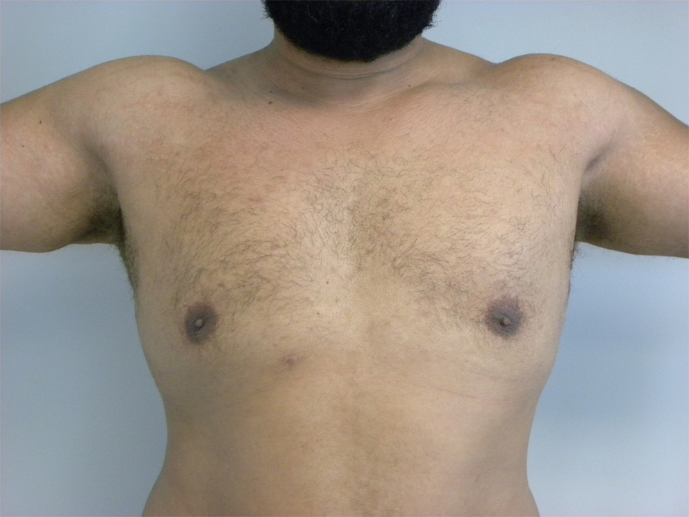 Liposuction and Gynecomastia Before and After Pictures Miami, FL