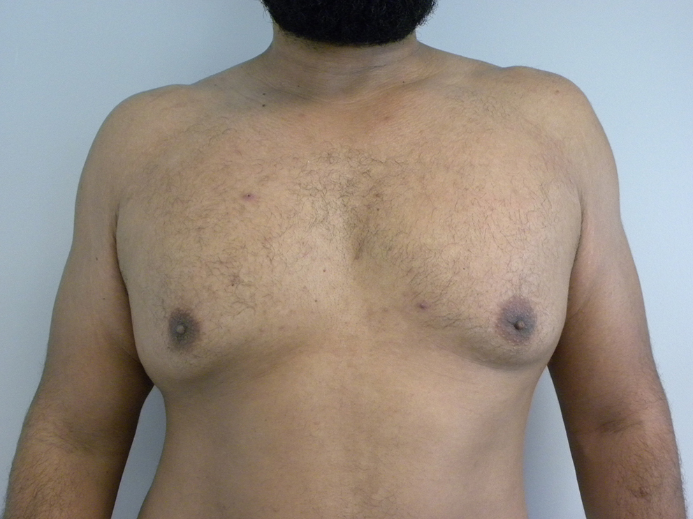 Liposuction and Gynecomastia Before and After Pictures Miami, FL