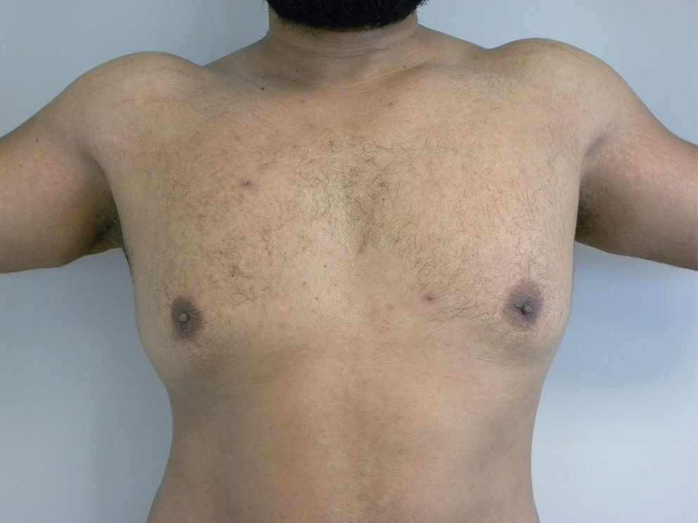 Liposuction and Gynecomastia Before and After Pictures Miami, FL