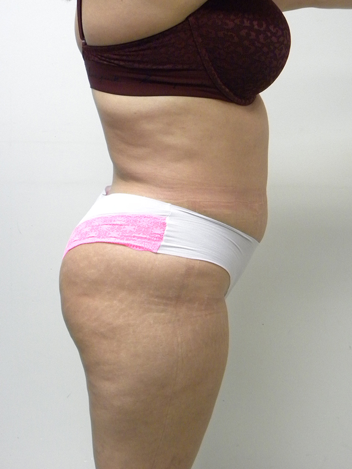 Liposuction Before and After Pictures Miami, FL