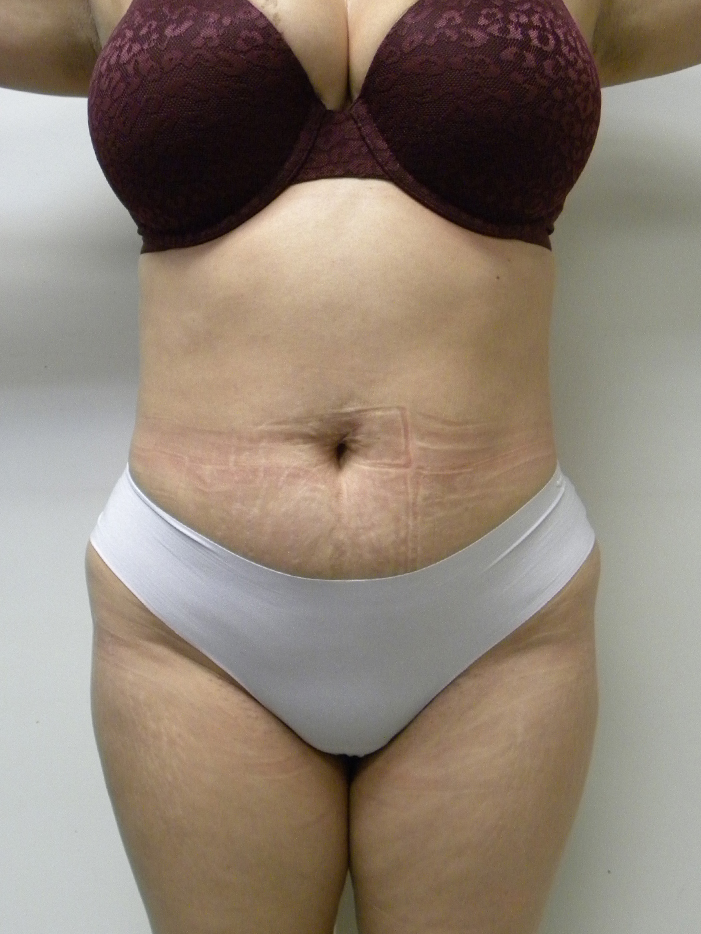 Liposuction Before and After Pictures Miami, FL