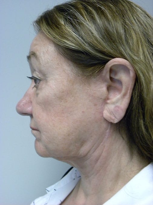 Neck Lift Before and After Pictures Miami, FL