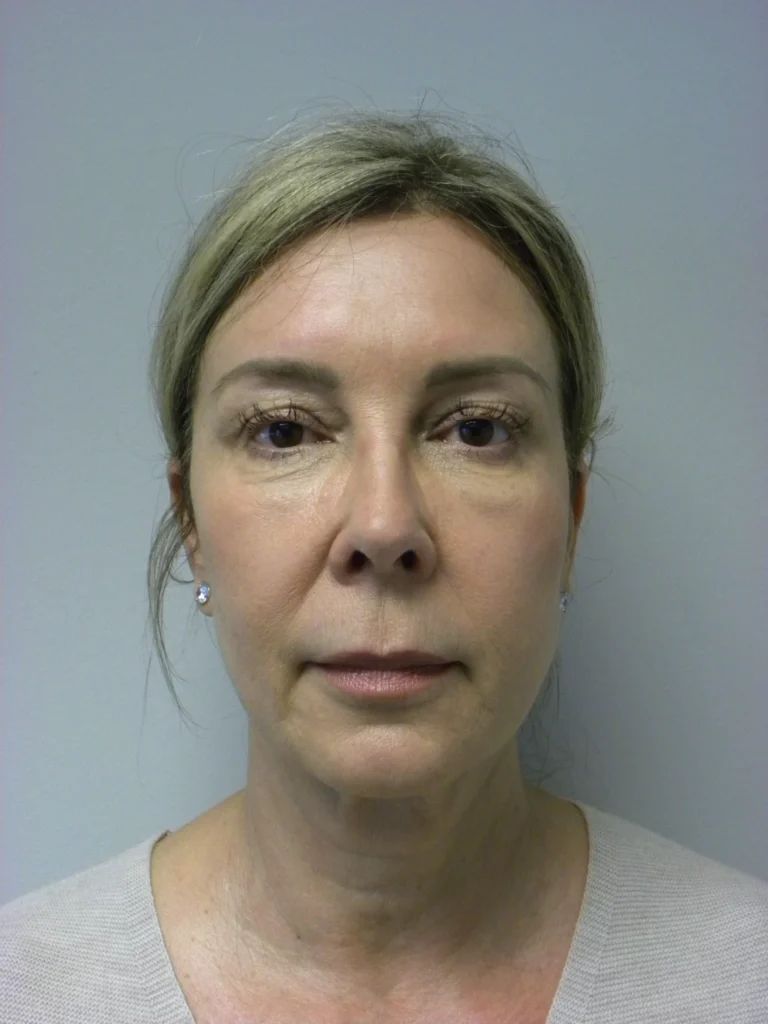 Plastic Surgery Before and After Pictures in Miami, FL - Dr. Adam J. Rubinstein 