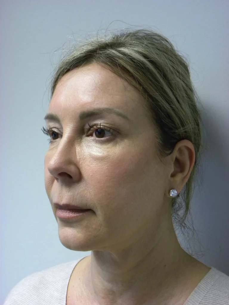 Plastic Surgery Before and After Pictures in Miami, FL - Dr. Adam J. Rubinstein 