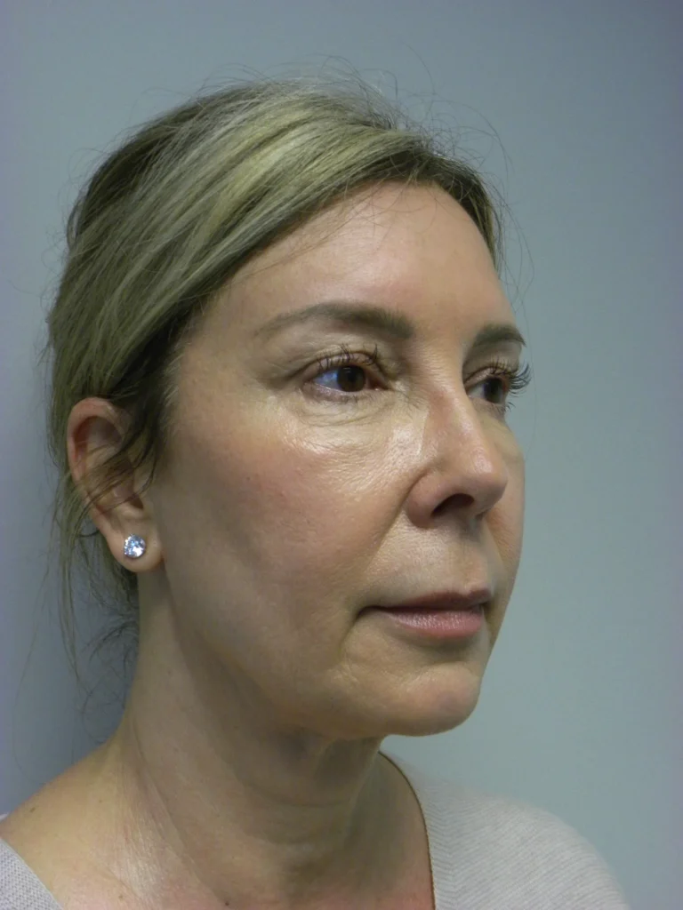 Plastic Surgery Before and After Pictures in Miami, FL - Dr. Adam J. Rubinstein 