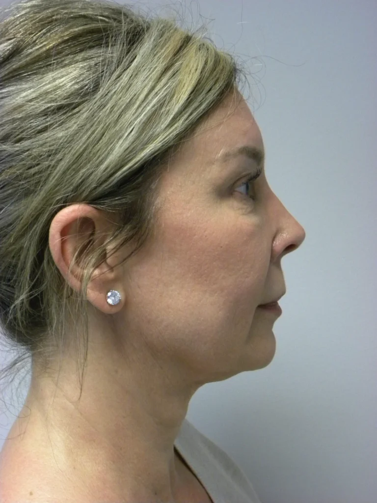 Plastic Surgery Before and After Pictures in Miami, FL - Dr. Adam J. Rubinstein 