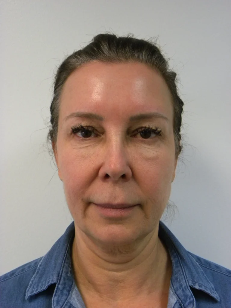 Plastic Surgery Before and After Pictures in Miami, FL - Dr. Adam J. Rubinstein 