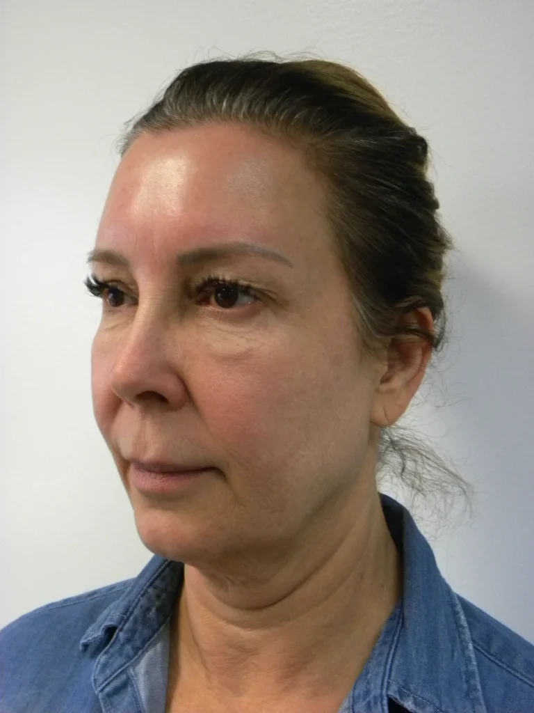 Plastic Surgery Before and After Pictures in Miami, FL - Dr. Adam J. Rubinstein 