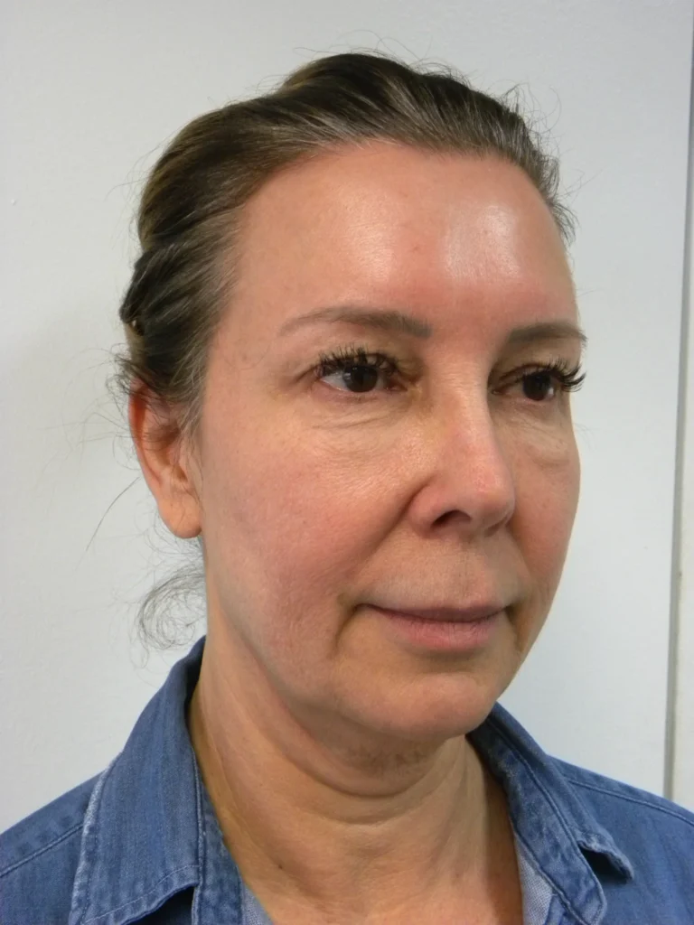 Plastic Surgery Before and After Pictures in Miami, FL - Dr. Adam J. Rubinstein 