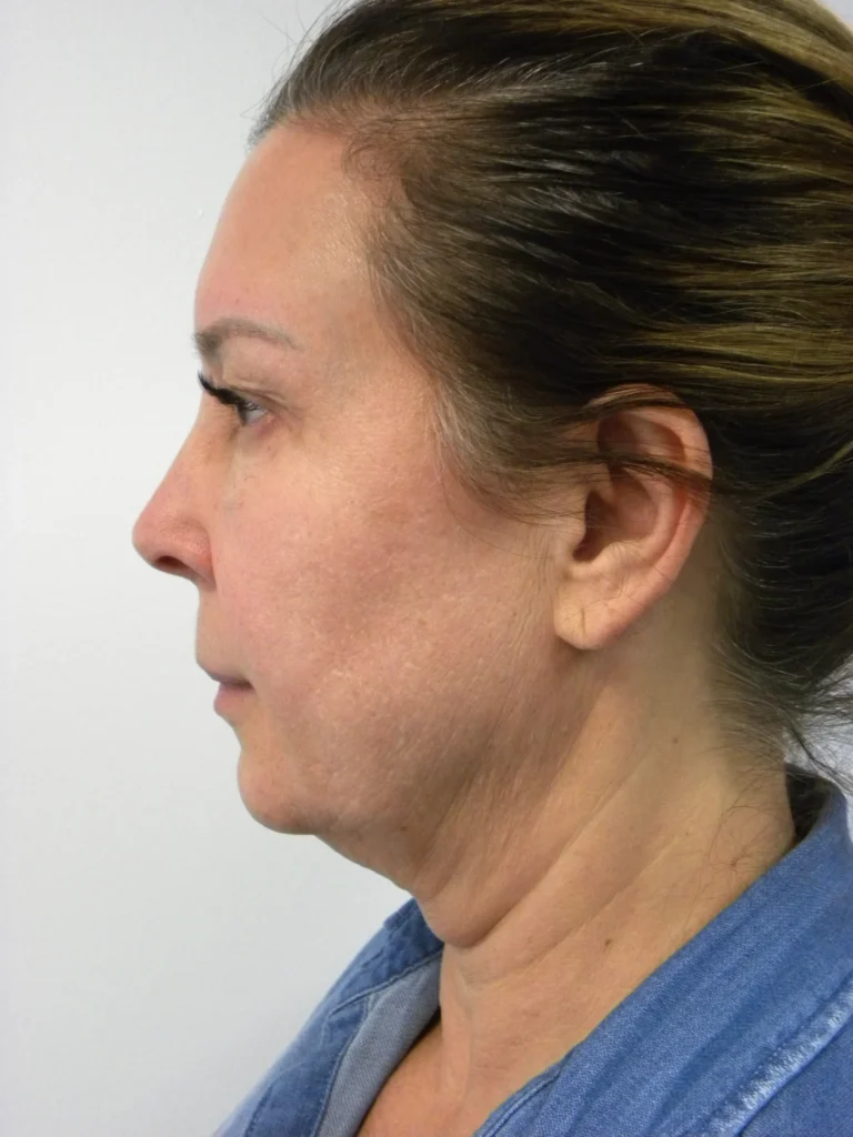 Plastic Surgery Before and After Pictures in Miami, FL - Dr. Adam J. Rubinstein 