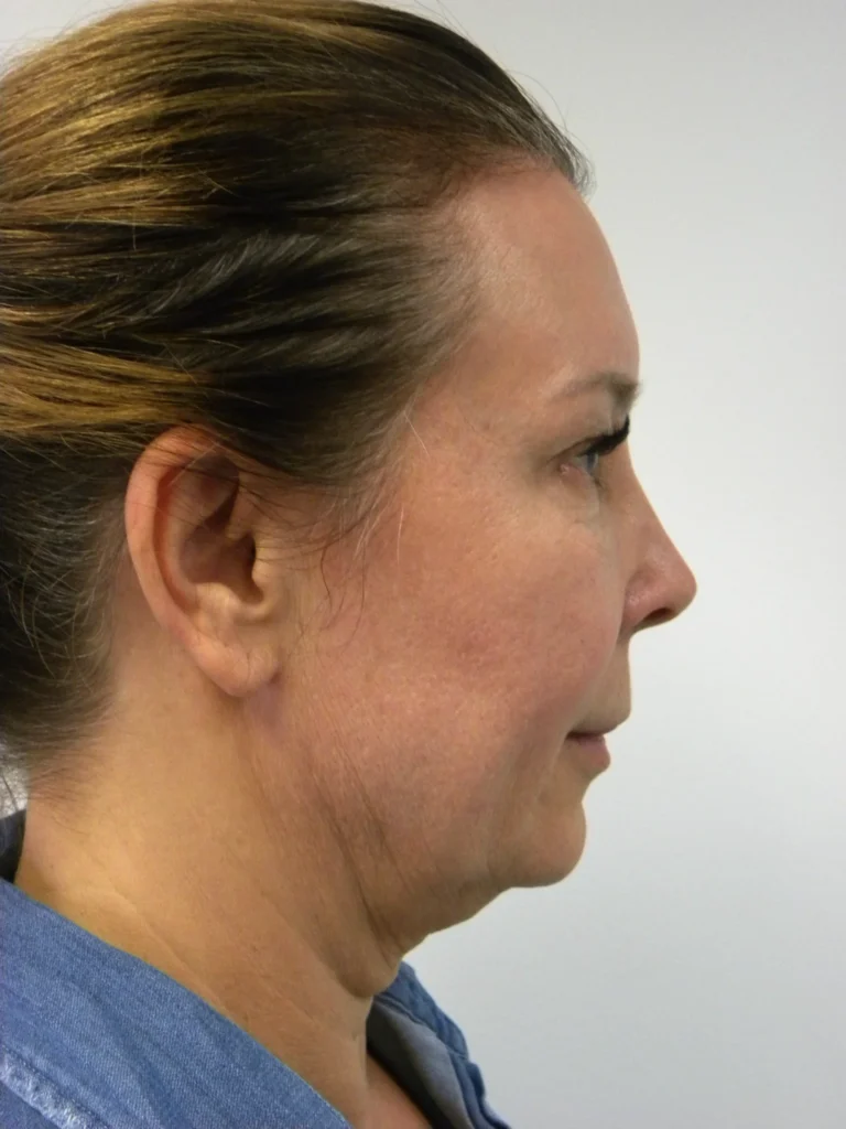 Plastic Surgery Before and After Pictures in Miami, FL - Dr. Adam J. Rubinstein 