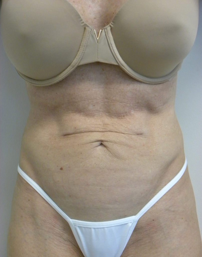 Renuvion™ Before and After Pictures Miami, FL