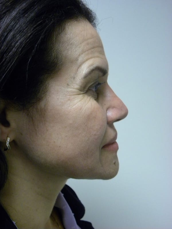 Rhinoplasty Before and After Pictures in Miami, FL