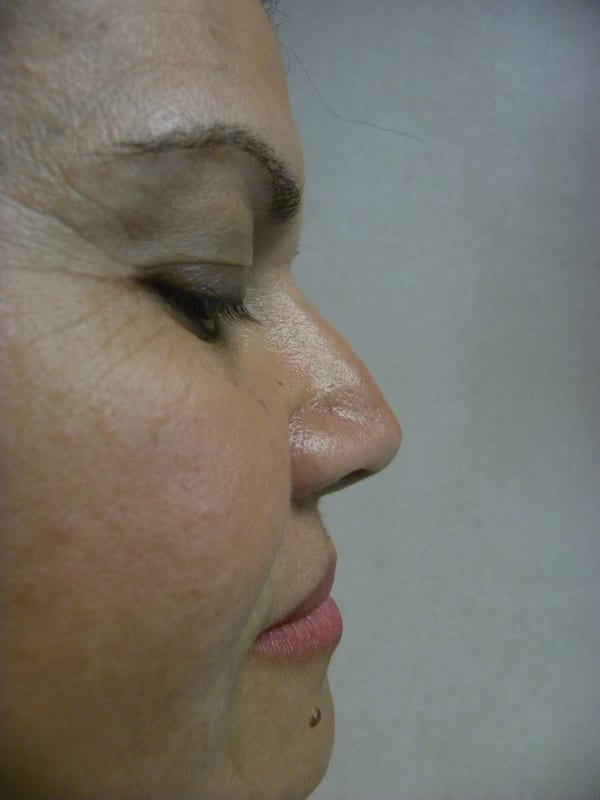 Rhinoplasty Before and After Pictures in Miami, FL
