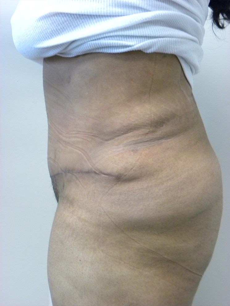 Tummy Tuck Before and After Pictures in Miami, FL