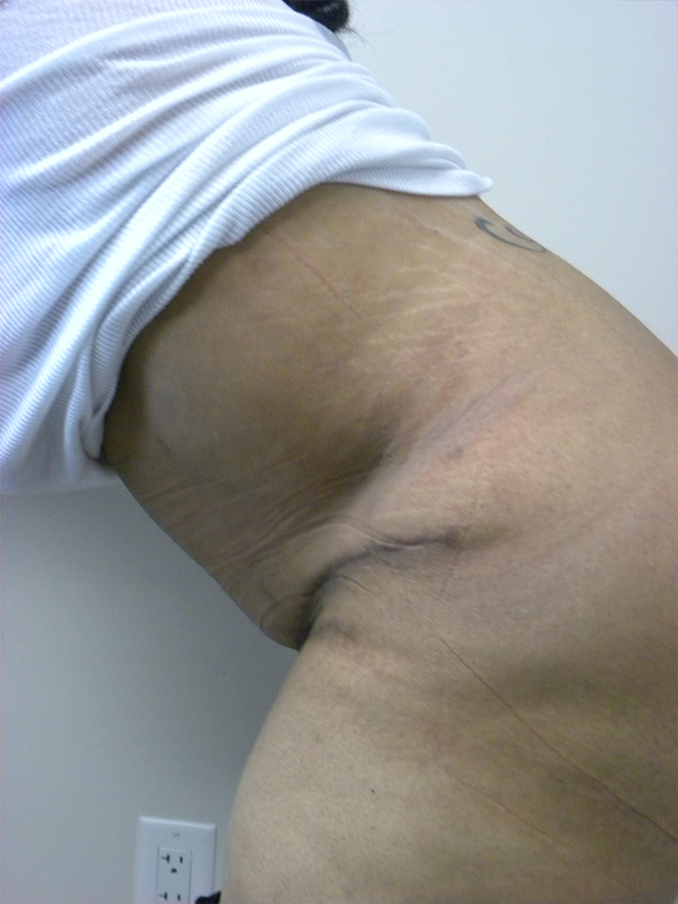 Tummy Tuck Before and After Pictures in Miami, FL