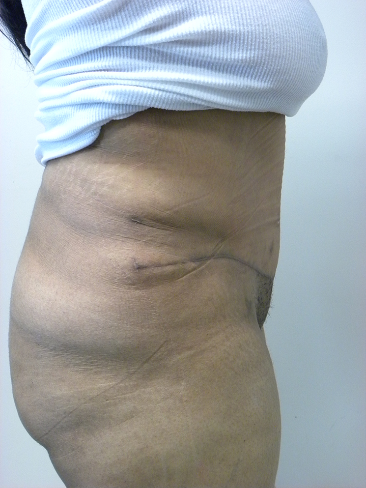 Tummy Tuck Before and After Pictures in Miami, FL