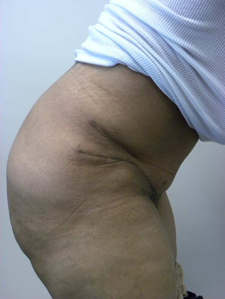 Tummy Tuck Before and After Pictures in Miami, FL