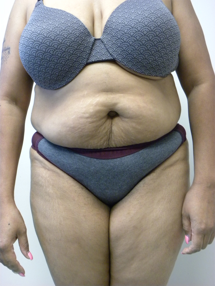 Tummy Tuck Before and After Pictures in Miami, FL