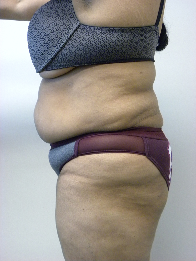 Tummy Tuck Before and After Pictures in Miami, FL