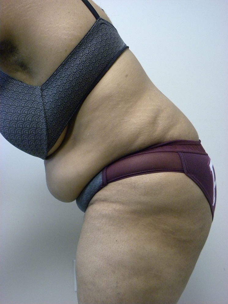 Tummy Tuck Before and After Pictures in Miami, FL