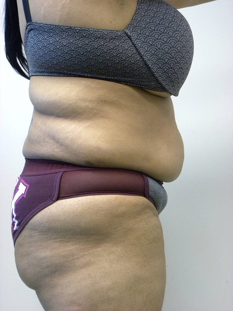 Tummy Tuck Before and After Pictures in Miami, FL