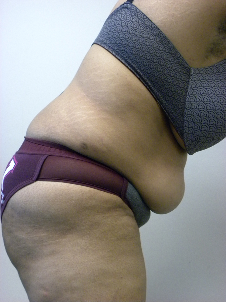 Tummy Tuck Before and After Pictures in Miami, FL