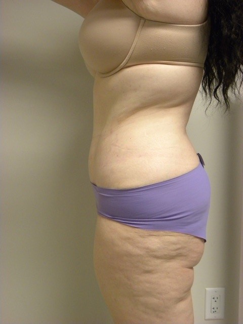 Tummy Tuck Before and After Pictures in Miami, FL