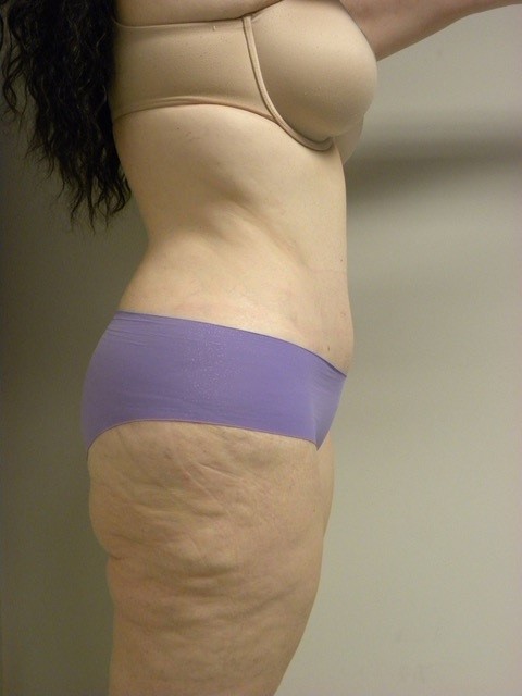 Tummy Tuck Before and After Pictures in Miami, FL