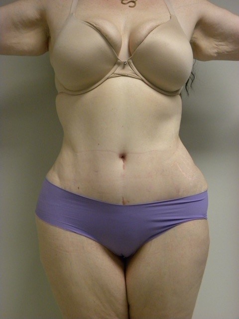 Tummy Tuck Before and After Pictures in Miami, FL