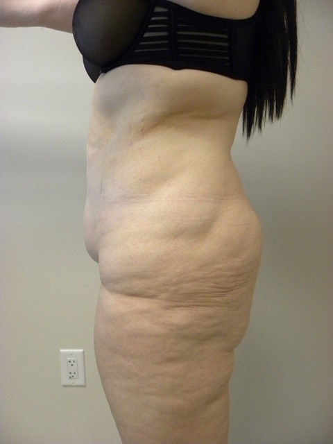 Tummy Tuck Before and After Pictures in Miami, FL