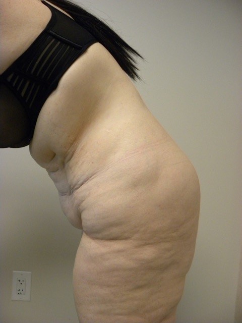 Tummy Tuck Before and After Pictures in Miami, FL