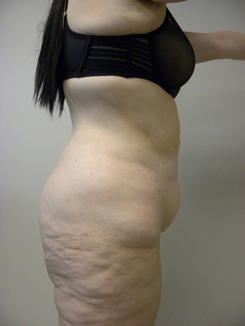 Tummy Tuck Before and After Pictures in Miami, FL