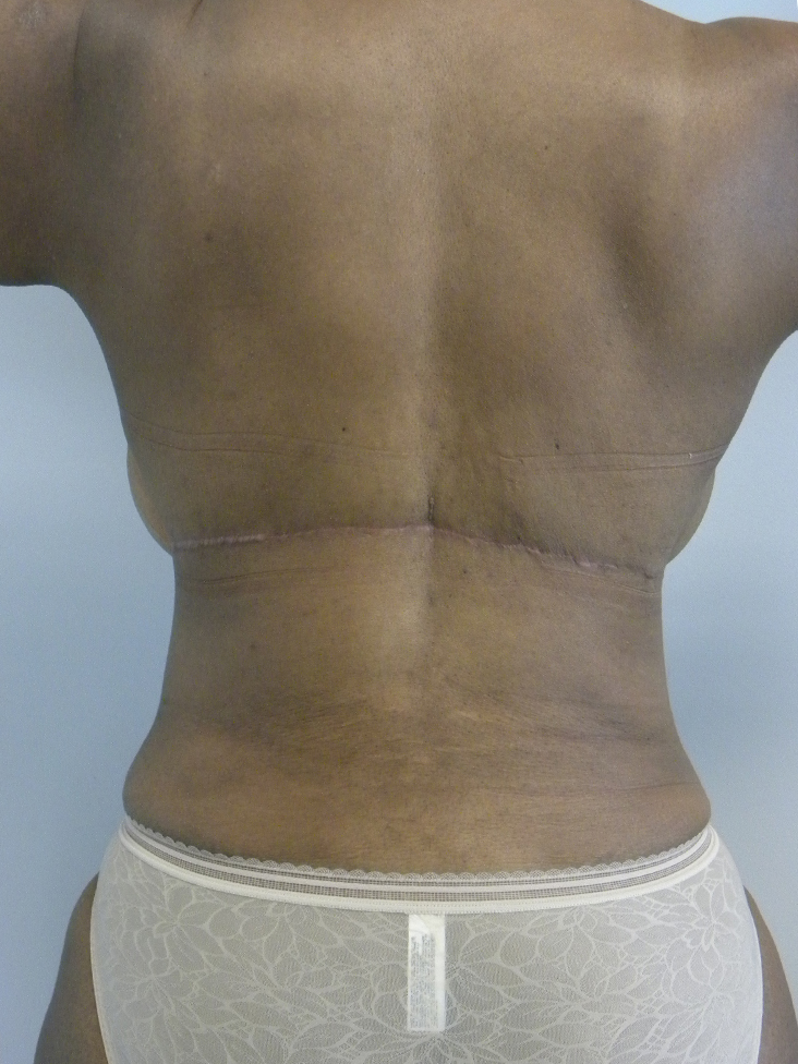 Tummy Tuck and Body Lift Before and After Pictures Miami, FL