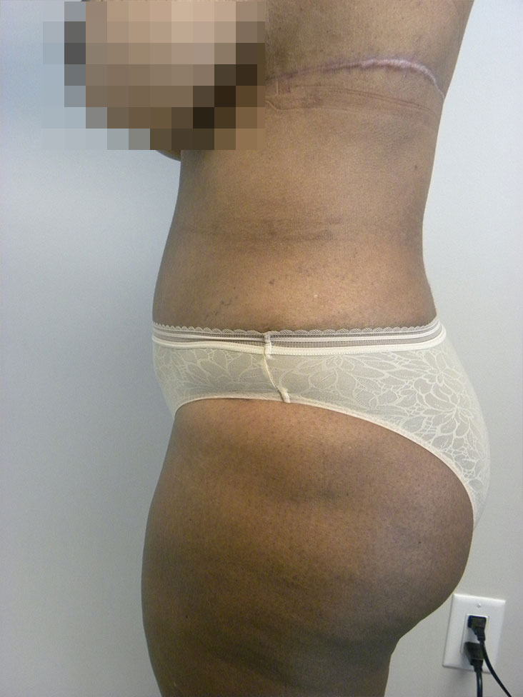 Tummy Tuck Before and After Pictures in Miami, FL