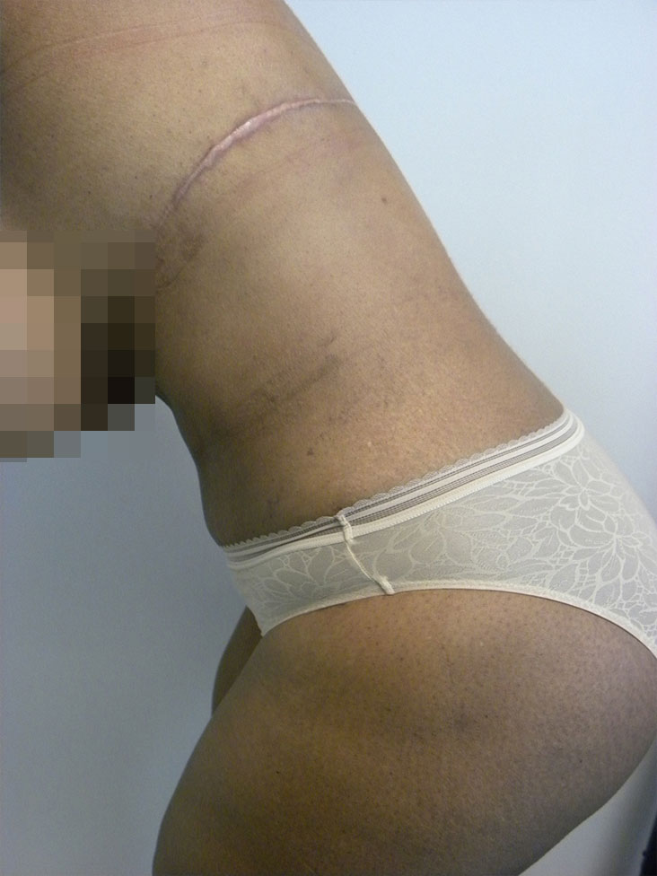 Tummy Tuck Before and After Pictures in Miami, FL