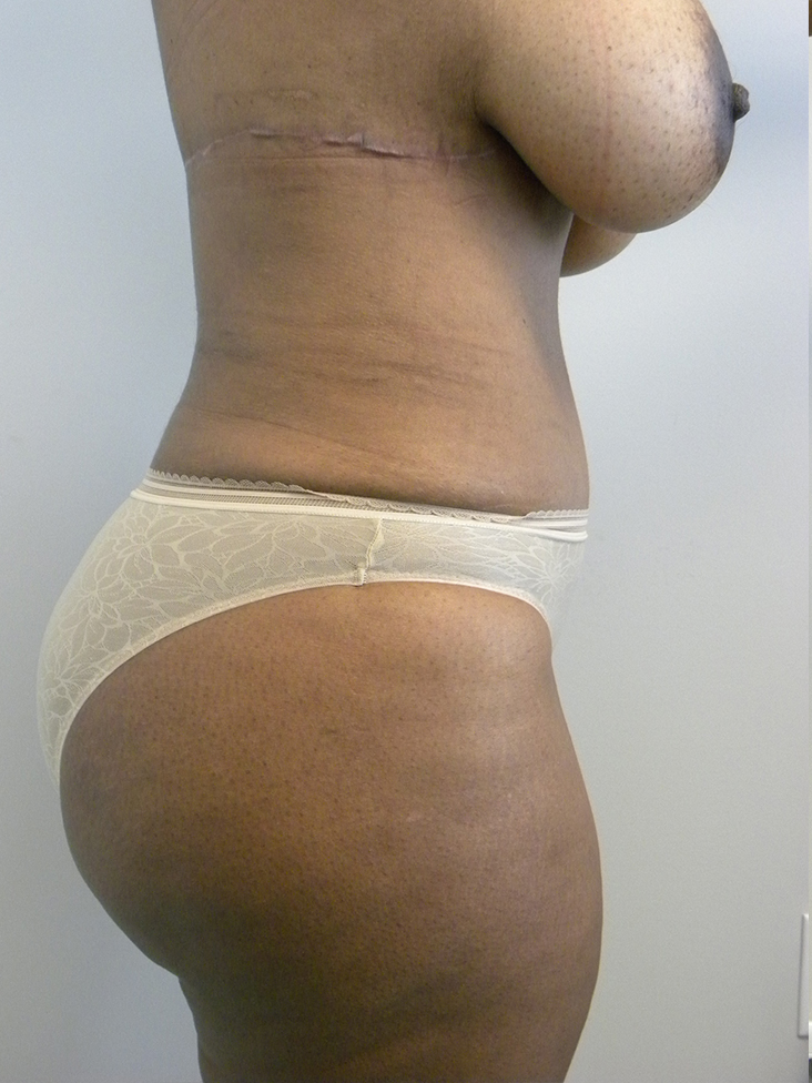 Tummy Tuck and Body Lift Before and After Pictures Miami, FL