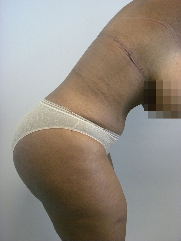 Tummy Tuck Before and After Pictures in Miami, FL