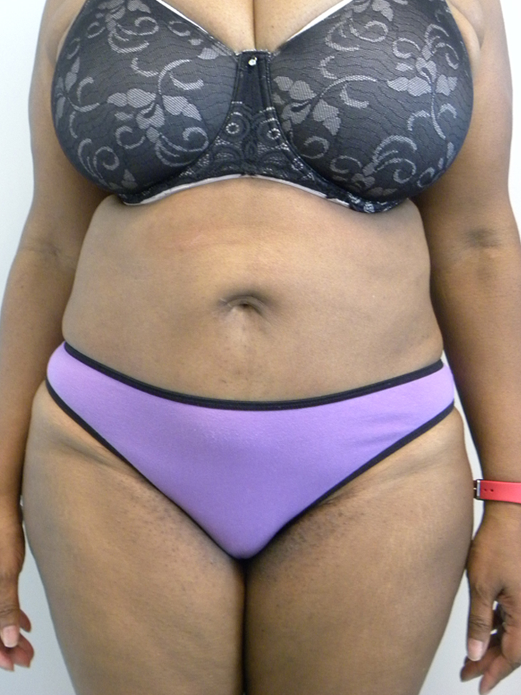 Tummy Tuck Before and After Pictures in Miami, FL