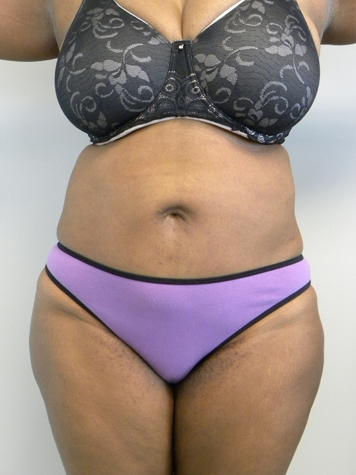 Tummy Tuck Before and After Pictures Miami, FL