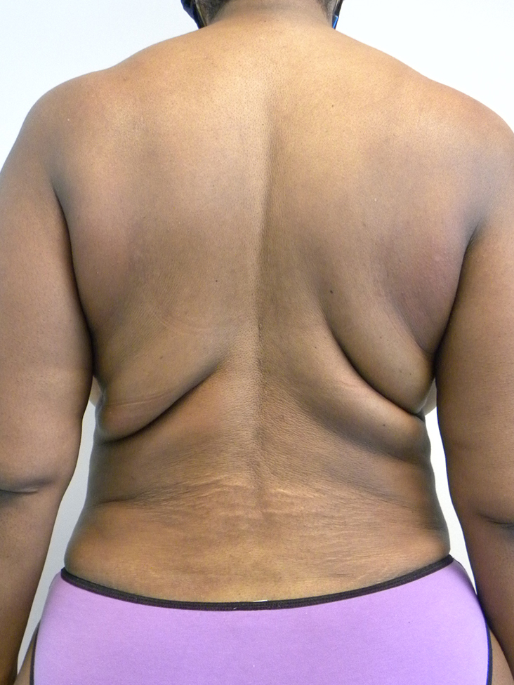 Tummy Tuck Before and After Pictures in Miami, FL