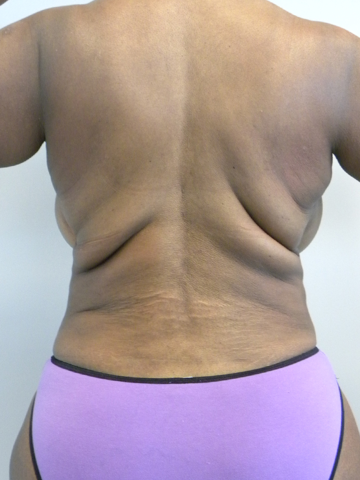 Tummy Tuck and Body Lift Before and After Pictures Miami, FL